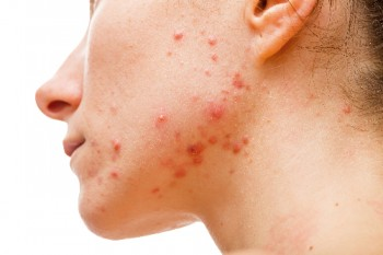 Why We Get Acne — Even as Adults Photos